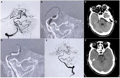 The short-term outcome of intracranial stenosis with distal thrombosis treated with balloon-assisted tracking